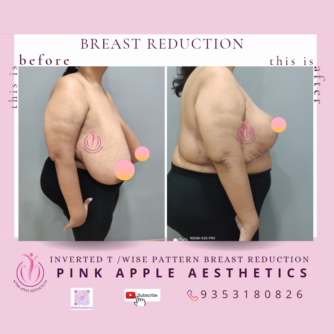 The Pros And Cons Of Breast Reduction