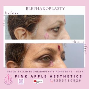 blepharoplasty 10