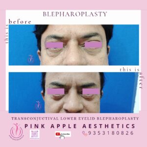 blepharoplasty 3