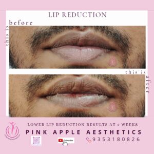 lip reduction 1