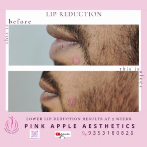 lip reduction 3