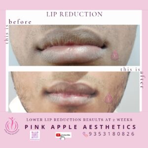 lip reduction 4