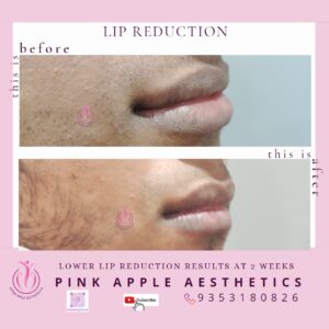 lip reduction 5