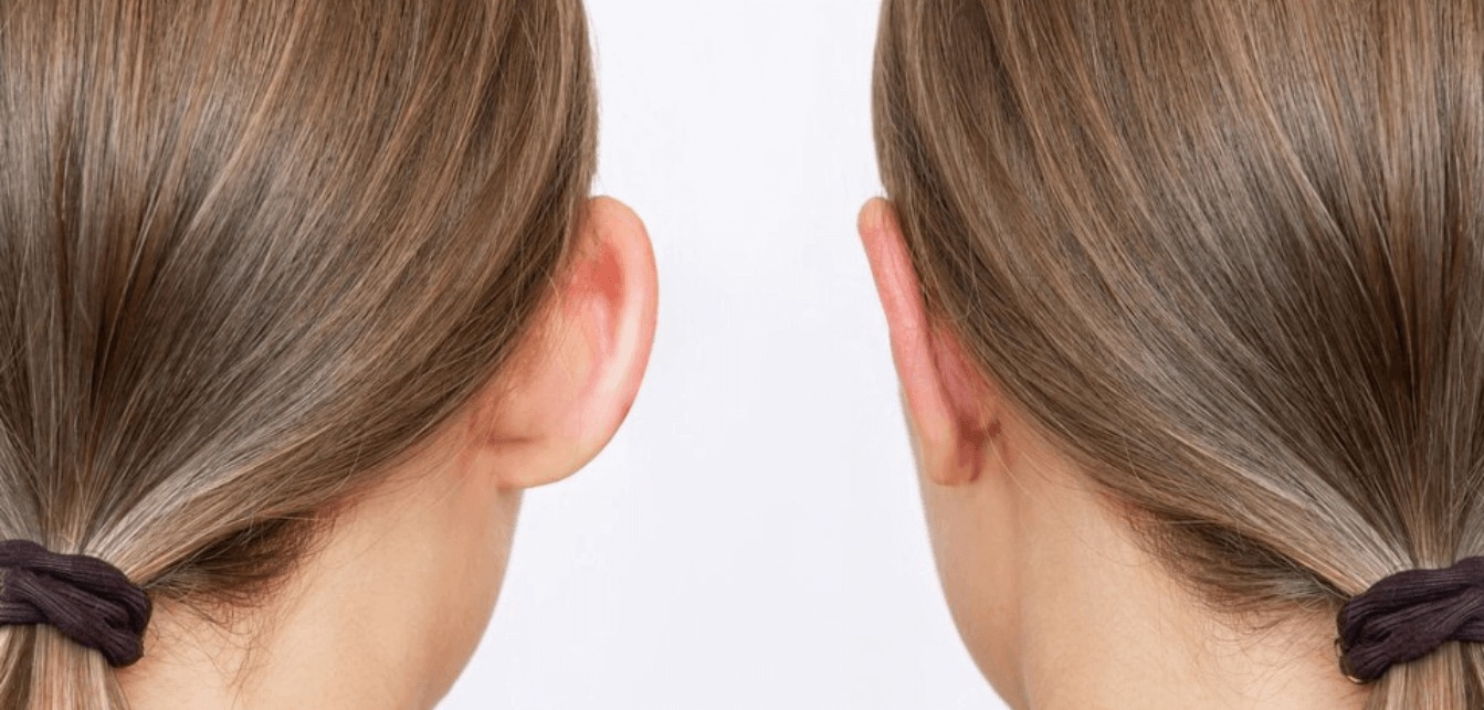 Marcrotia Ear Reduction