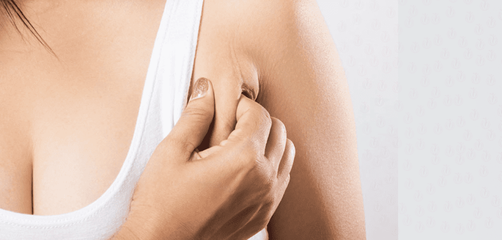 Axillaplasty