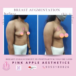 BREAST AUGMENTATION 6