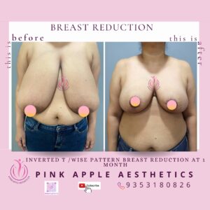 BREAST REDUCTION 1