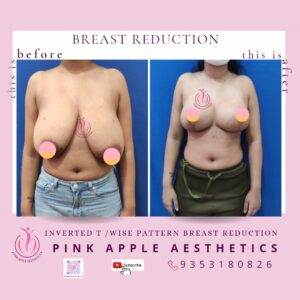 BREAST REDUCTION 10