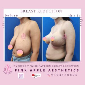 BREAST REDUCTION 13