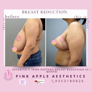 BREAST REDUCTION 2
