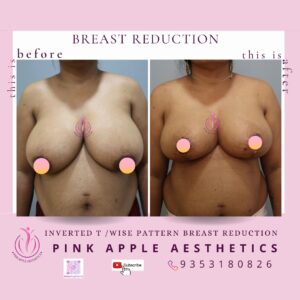 BREAST REDUCTION 4