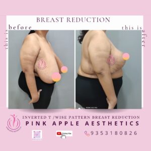 BREAST REDUCTION 5