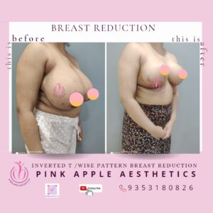 BREAST REDUCTION 8