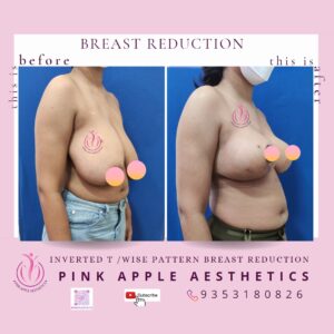 BREAST REDUCTION 9