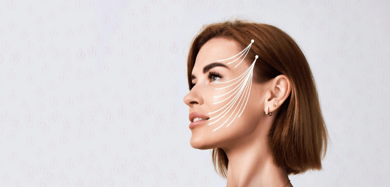 Thread Lift