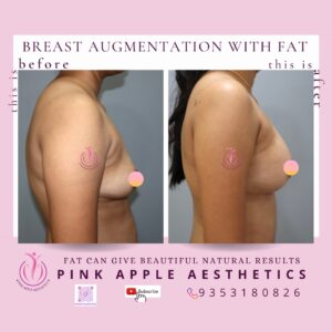 breast augmentation with fat 1