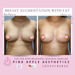 breast augmentation with fat 3