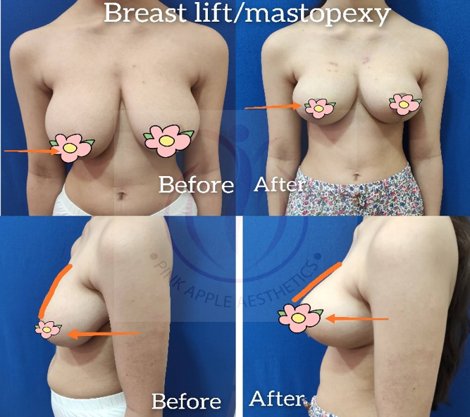 Vertical Scar Breast Reduction Surgery Before and After