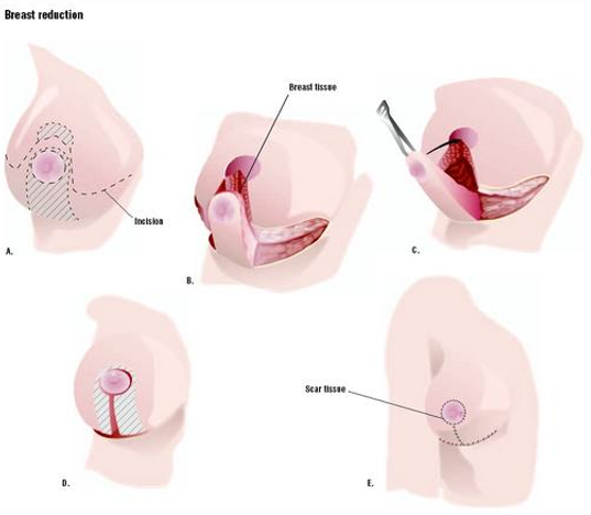 Steps for Breast Reduction Surgery