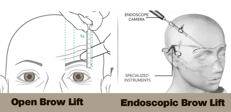 Endoscopic and Open Brow Lift