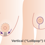 Vertical Scar Breast Reduction Surgery