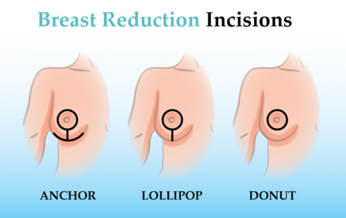 Types of Breast Reduction