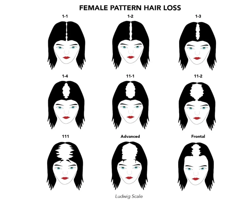 Female hair loss- Ludwig