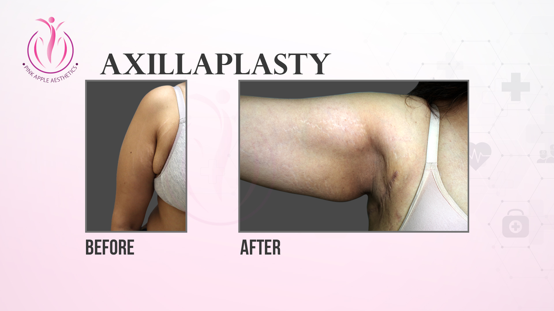Axillaplasty surgery in Bangalore | Plastic surgeon In Bangalore