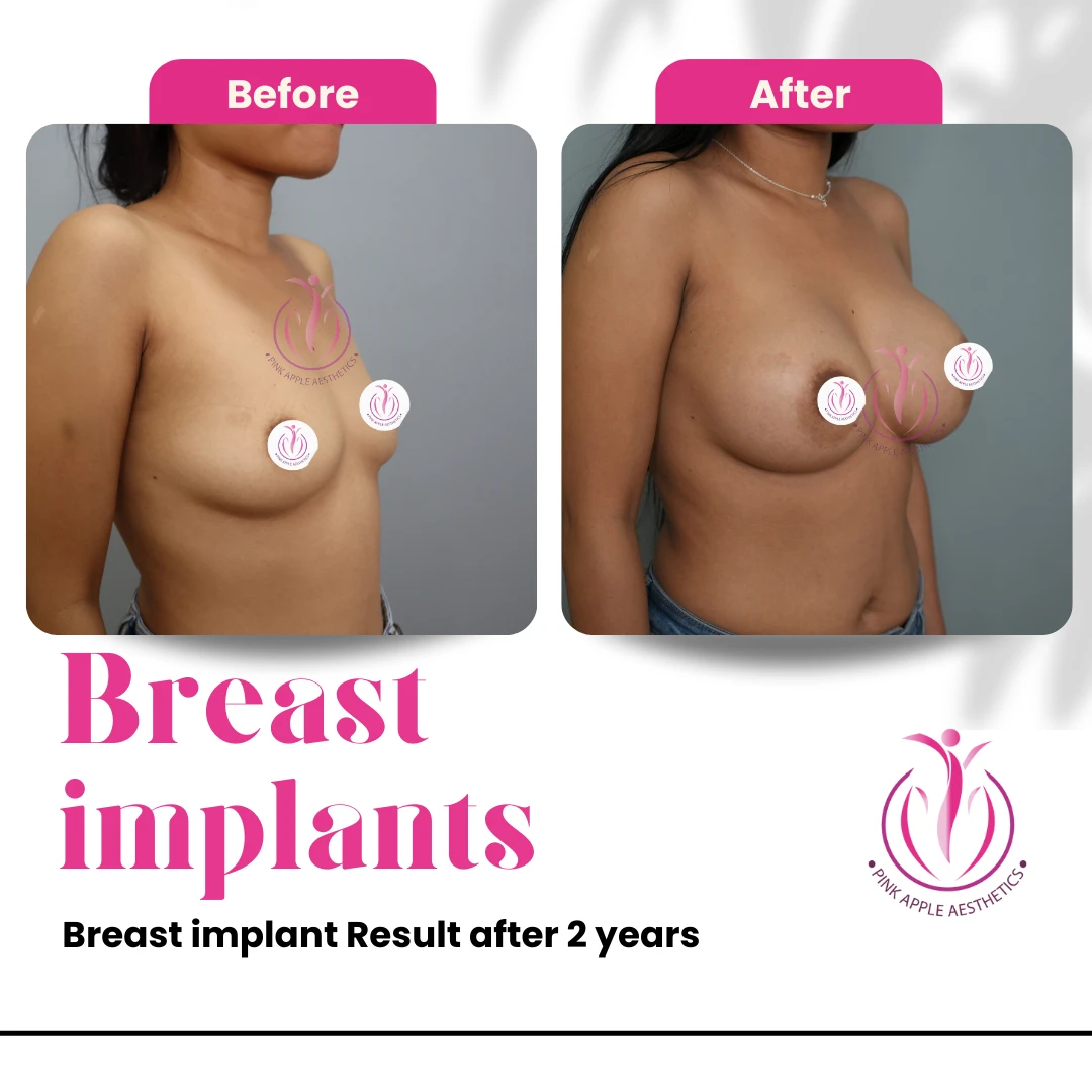 Breast Implant Surgery 12 2 years post-surgery results of breast implant augmentation performed by leading cosmetic surgeon in Bangalore at Pink Apple Aesthetics