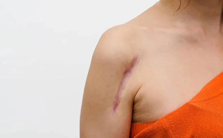 non-surgical-surgical-keloid-removal