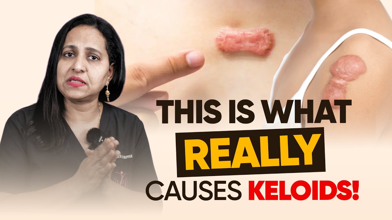 What is the best treatment for keloid?