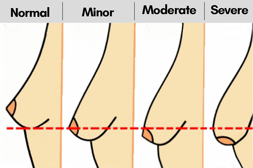 causes-of-breast-sagging
