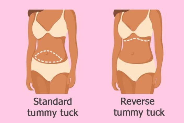 standard-vs-reverse-tummy-tuck