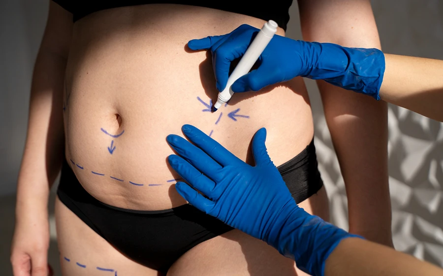 Liposuction cost comparison in Bangalore and India 2025 - body fat measurement