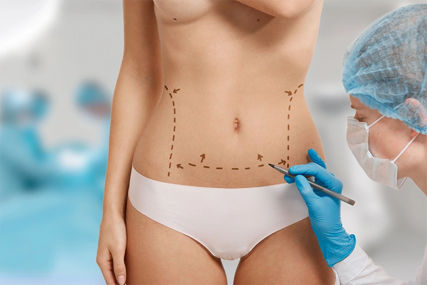Liposuction procedure in Bangalore showing abdomen fat removal markings