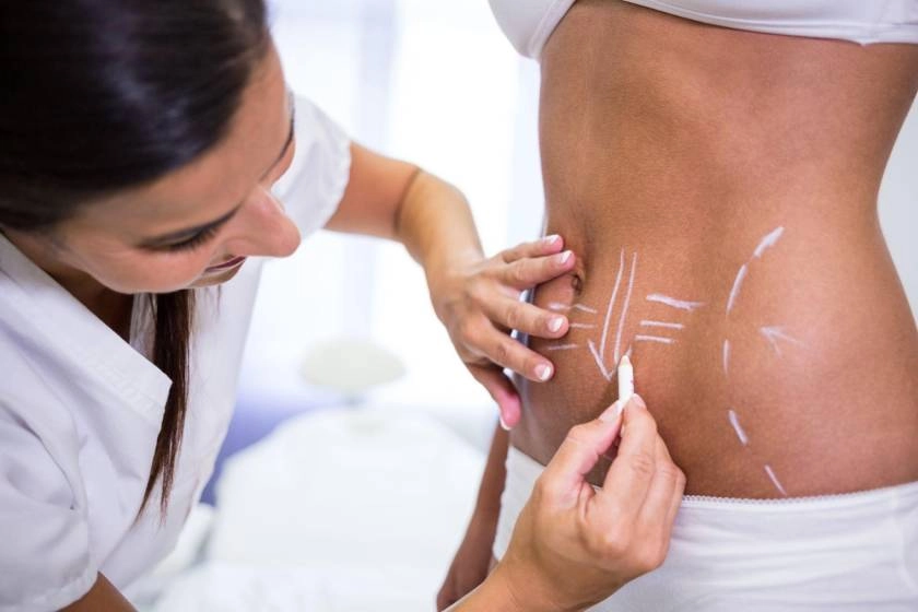 Surgeon marking abdominal area for liposuction body contouring procedure