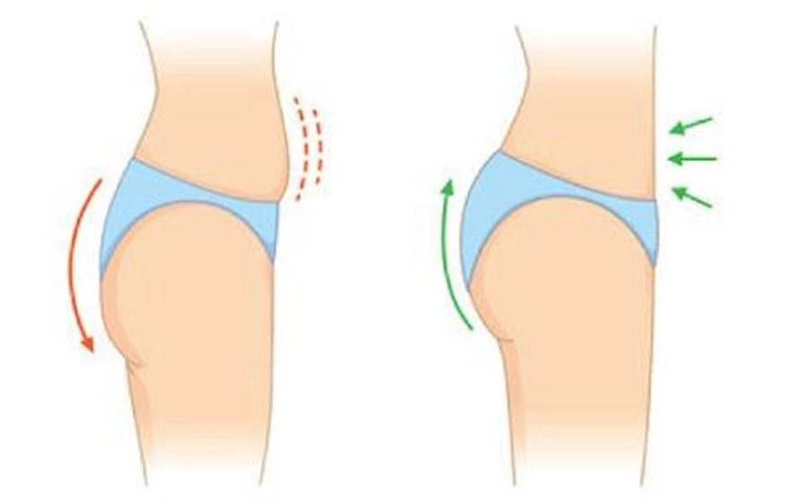 Miami Thong Lift before and after results 2025 showing hidden scar butt lift and natural curves