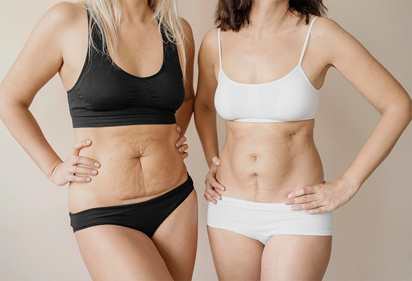 Mommy makeover surgery before and after results in India showing post-pregnancy body transformation