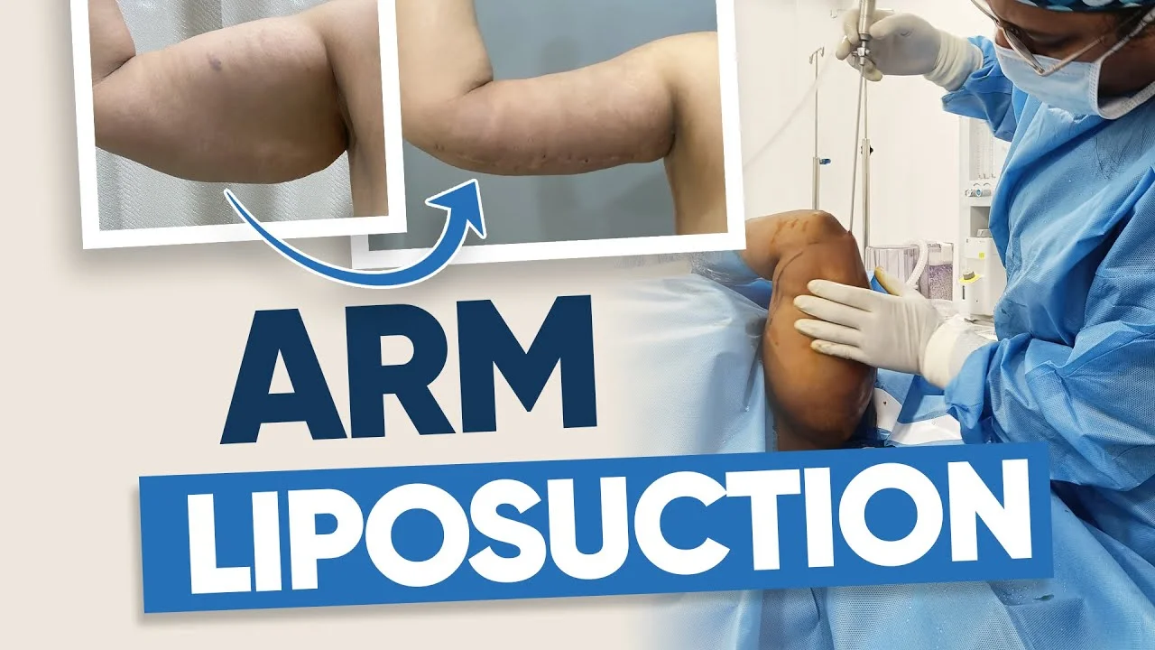 Arm-liposuction-video-banner