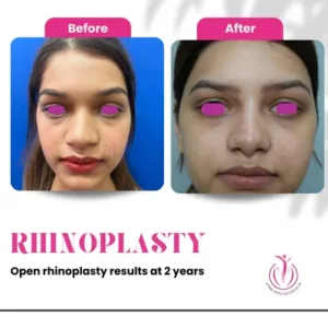 Rhinoplasty-7-home-opt