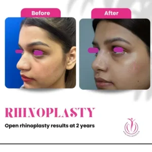 Rhinoplasty-8-home-opt