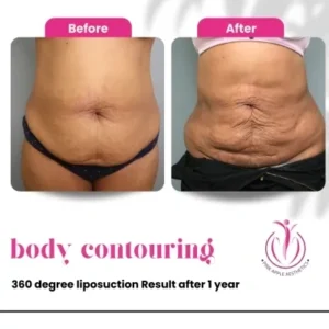 body-contouring-1-home-opt