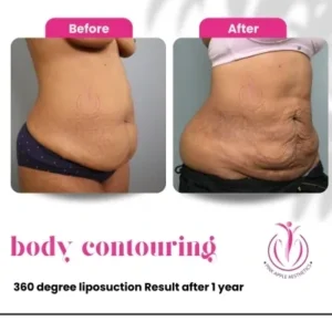 body-contouring-2-home-opt