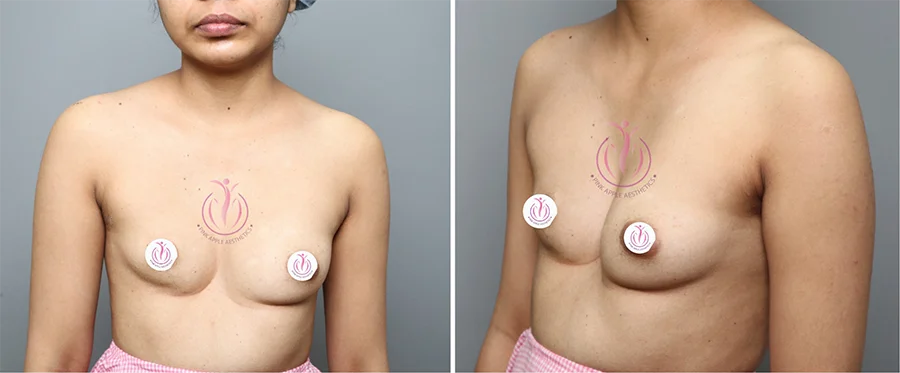 Breast Asymmetry Correction: Insights from a Plastic Surgeon on Breast Augmentation Surgery in Bangalore 2 breast-asymmetry-before-and-after-surgery
