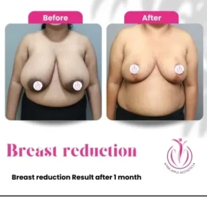 breast-reduction-3-home-opt