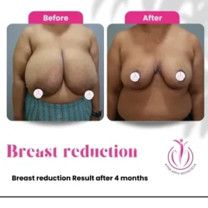breast-reduction-4-home-opt