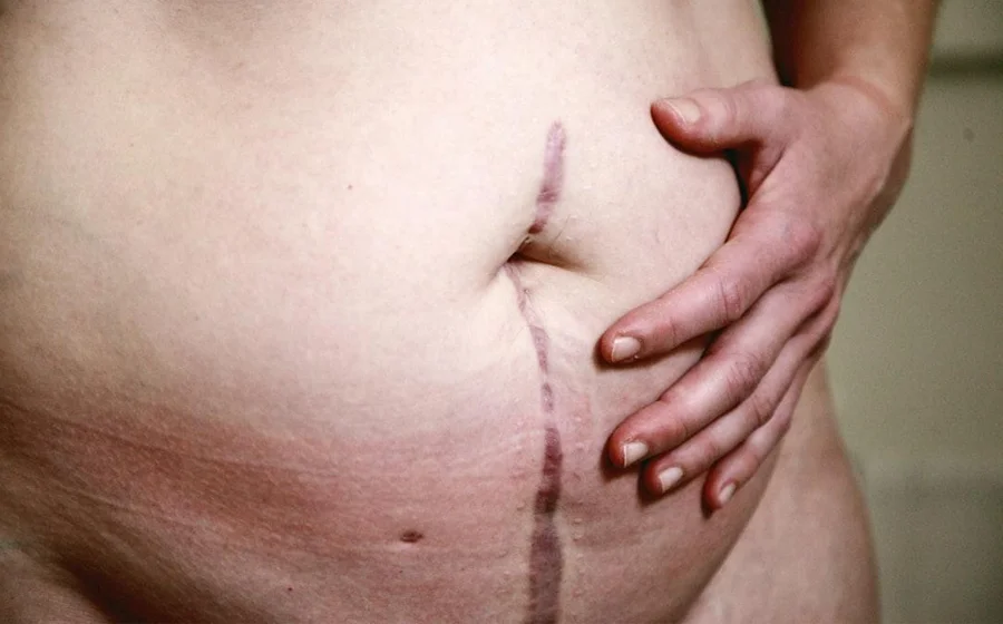 Close-up image showing post-liposuction surgical scar on the abdomen, illustrating recovery process and typical appearance after liposuction surgery in Bangalore
