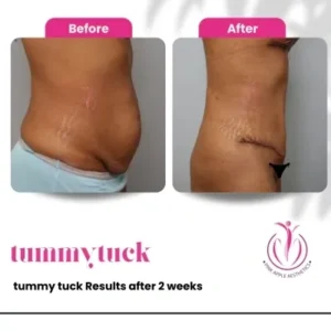 tummy-tuck-5-home-opt