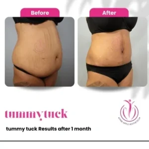 tummy-tuck-6-home-opt