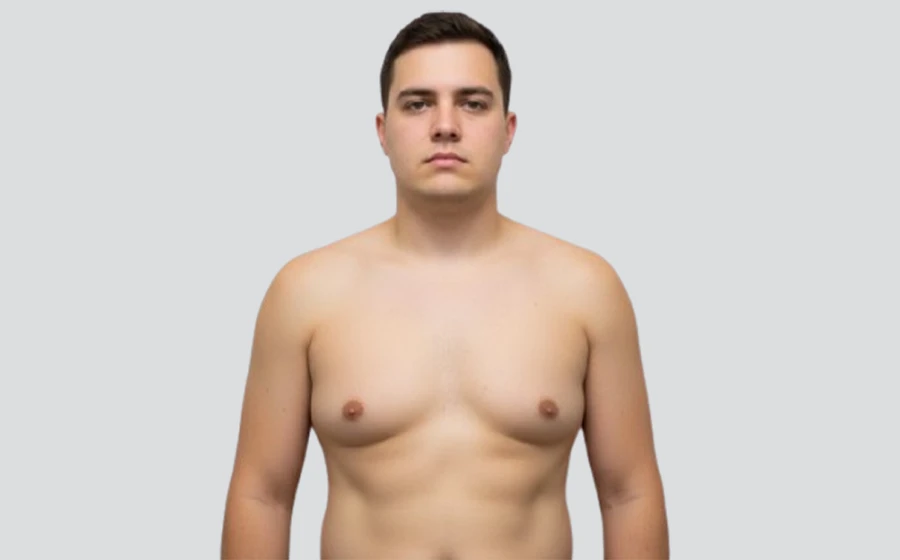 Male torso showing signs of gynecomastia before surgery, illustrating enlarged male breast tissue.